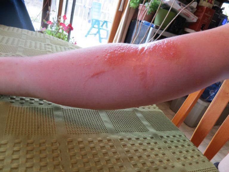 Poison Ivy Rashes How You Can Heal It Clamon Natural Health