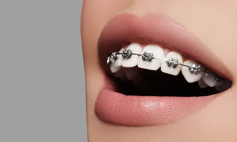 Straighten Your Teeth With Orthodontics