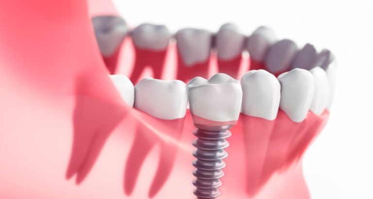 A Pain-Free Dental Implant Experience: The Crucial Role of Anesthesia Dental Implant