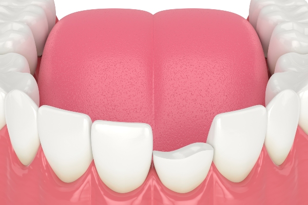 Restoring Smiles with Porcelain Veneers: A Solution for Chipped Teeth