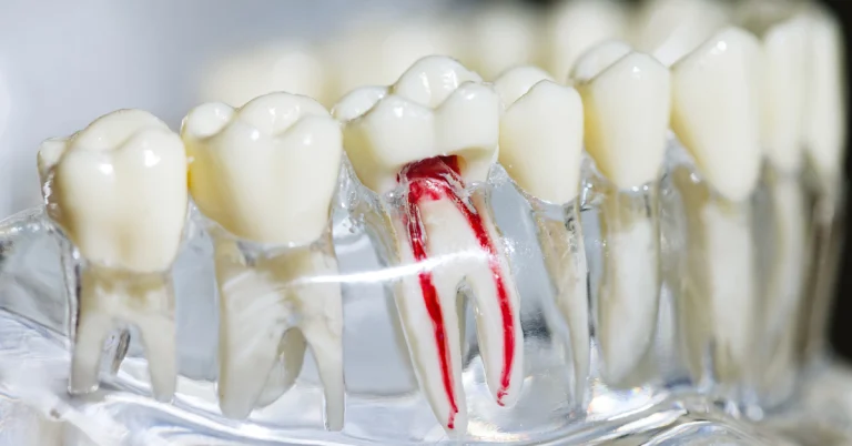 Advances in Endodontic Surgery: Revolutionizing Root Canal Treatment